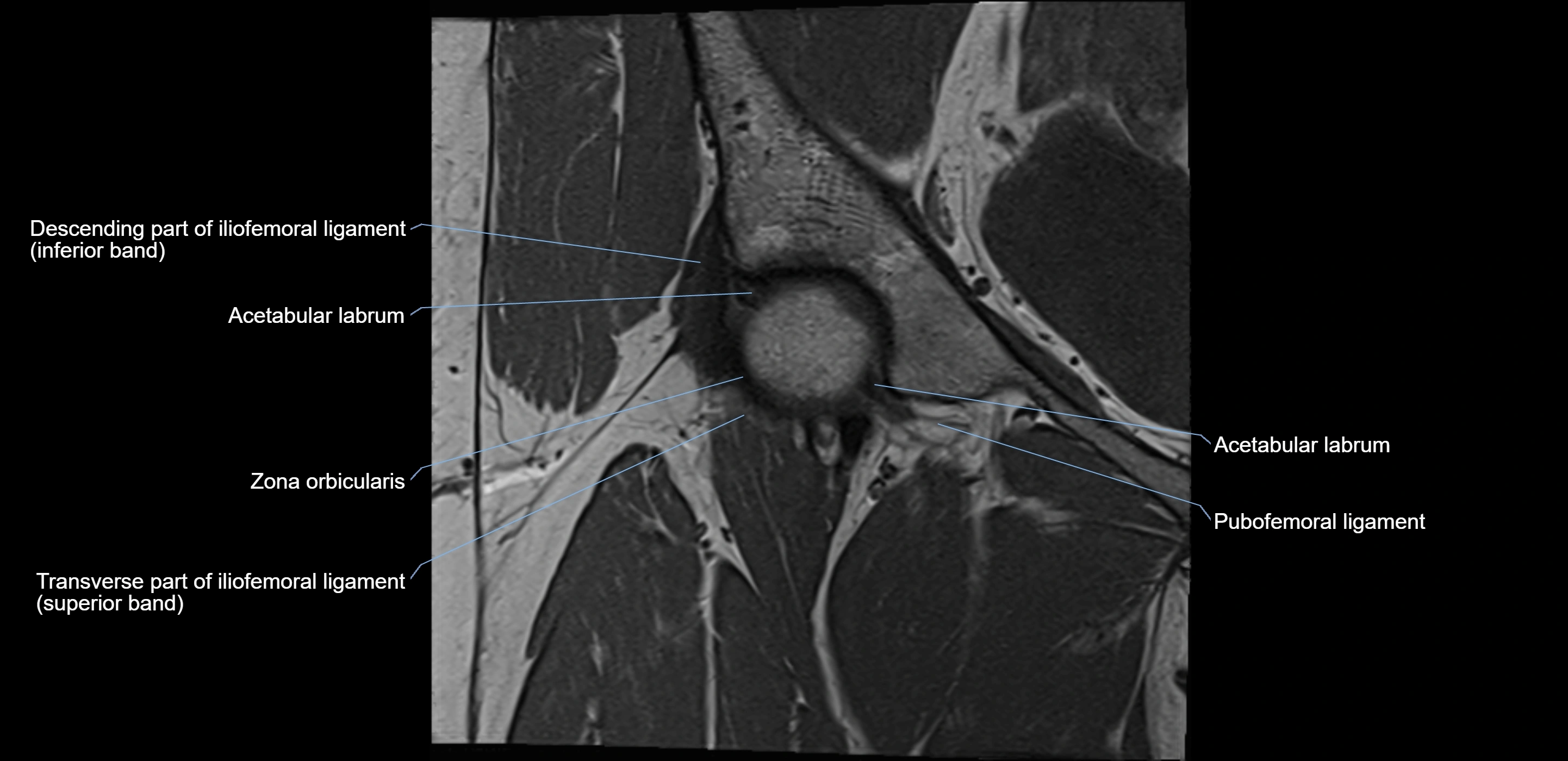 MRI Hip ligaments coronal cross sectional anatomy 3T  radiology  image-img-00001-00005.webp